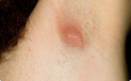Lipomas (a benign fat tissue. Armpit Cyst: Causes, Symptoms, Pictures, Cyst, Removal ...