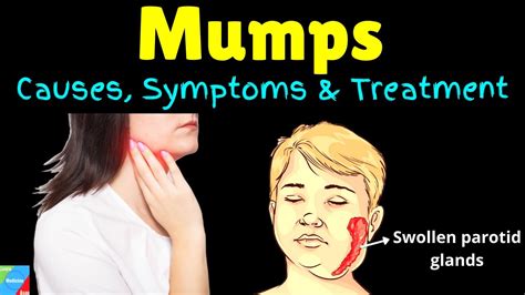 Mumps Symptoms Causes Treatments And Complications Youtube
