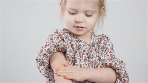 Discovernet Eczema Explained Causes Symptoms And Treatments