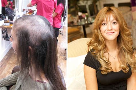 Pulling Out Hair Disorder Left Teen Bald But Now She Has The Locks Of