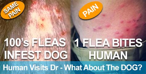 Infected Flea Bites On Humans