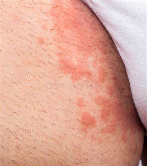 Eczema Groin Stock Photo Image Of Atopic Medicine Hives 51330818