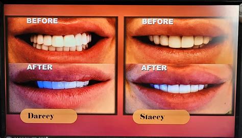 their teeth were so good before though i know darcey already had veneers stacey s teeth were