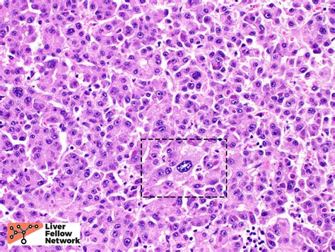 Pathology Pearls Hepatocellular Carcinoma Aasld