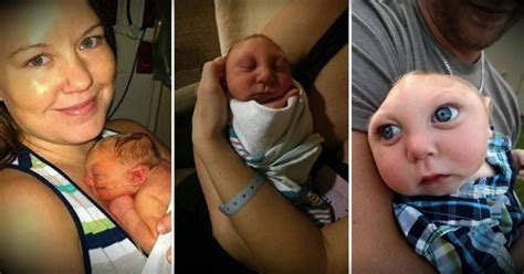 Miracle Boy With Partial Skull And Brain Turns One