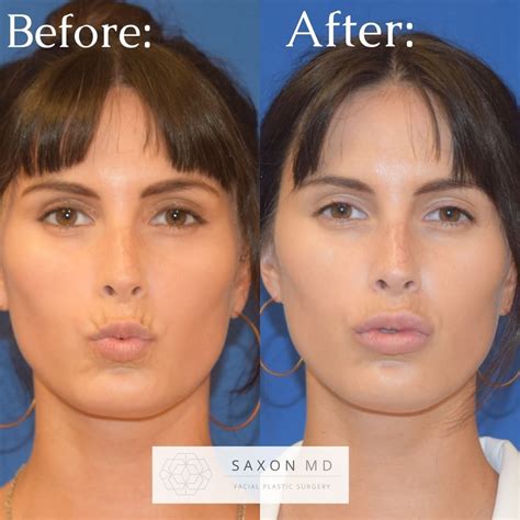 before and after of lip filler notice how the filler only injected into the lips also acts to