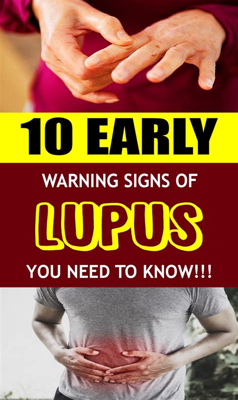 Early Warning Signs Of Lupus You Need To Know Momy Malaysia