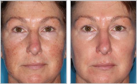 Halo Laser Technology Before After