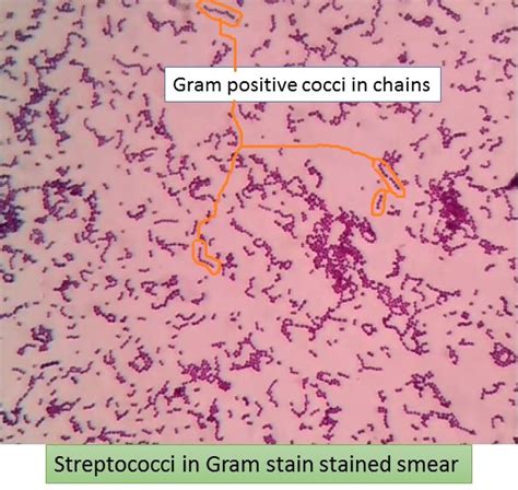 Streptococcin In Gram Stain Showing Gram Positive Cocci In Chains