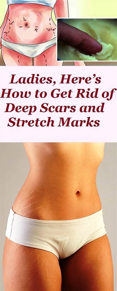Pin On Get Rid Of Stretch Marks