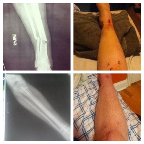 Also Recently Had Reconstructive Surgery Tibfib Fracture Doing
