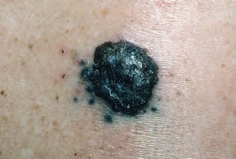 Over the past decade, people have gotten more serious about sun protection and for one very good reason — melanoma. Melanomul - Tratament si Preventie