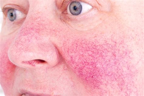 How To Get Rid Of Broken Capillaries On The Face Fast
