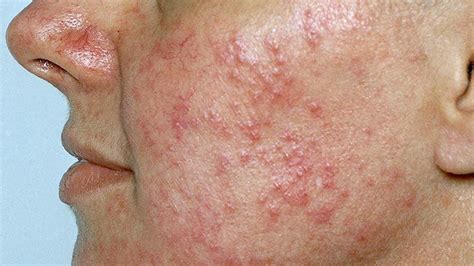 What Is Rosacea Symptoms Causes Diagnosis Treatment And Prevention