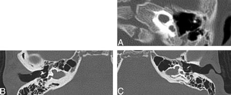 Three Axial Ct Images At The Level Of The Cochlea Demonstrating
