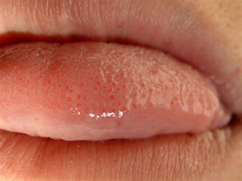 Why Tongue Pain Happens And How To Cure It Healthy Flat