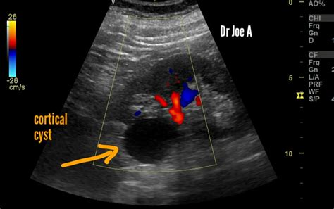 Ultrasound Imaging Simple Renal Cyst