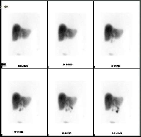 Hida Scan Showing Non Accumulation Of The Isotope Within The