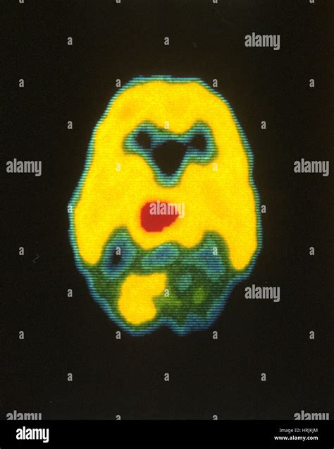 Malignant Brain Tumor Pet Scan Stock Photo Alamy