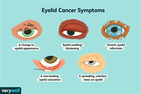 Eyelid Cancer Signs Causes And Treatment