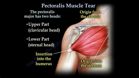 Pectoralis Muscle Tendon Tear Everything You Need To Know Dr