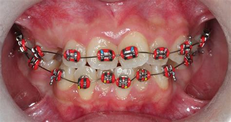 We hope that we can do the same for you and your family. How Does Wearing Braces Feel Like? | MySmileCT
