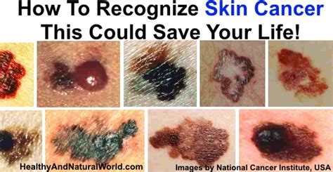 Warning Signs Of Melanoma The Most Deadly Form Of Skin Cancer