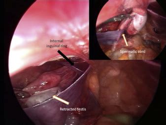 Laparoscopic Bilateral Gonadectomy And Inguinal Hernia Repair With Mesh