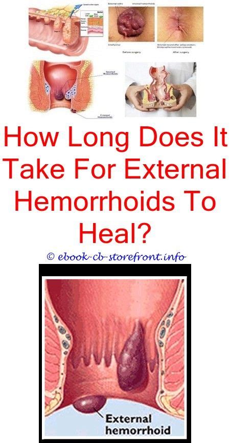 13 Astonishing Hemorrhoid Relief Remedies Ideas Bleeding Hemorrhoids
