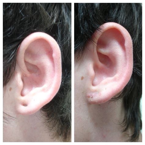 Earlobe Repair2 The Cosmetic Laser And Skin Cancer Centre