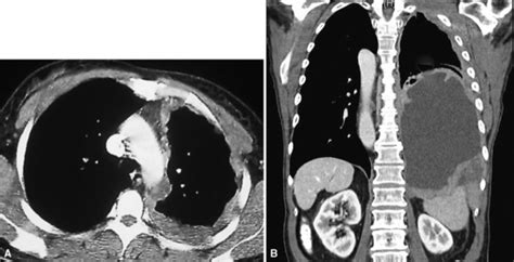 Malignant And Borderline Mesothelial Tumors Of The Pleura Clinical Gate