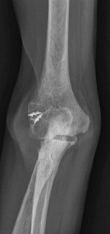 A Ap And B Lateral Radiographs Of The Right Elbow Obtained Upon The