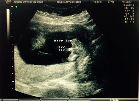Image First Look Sonogram