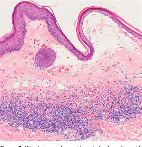 Figure 2 From Bullous Hemorrhagic Lichen Sclerosus Of The Breast A