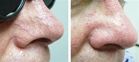 Ipl Therapy Before And After Kingsway Dermatology