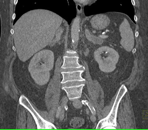 Axillary Nodes Subcutaneous Nodules And Adrenal Metastases In A