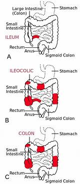 Images of Biologics For Ulcerative Colitis Side Effects