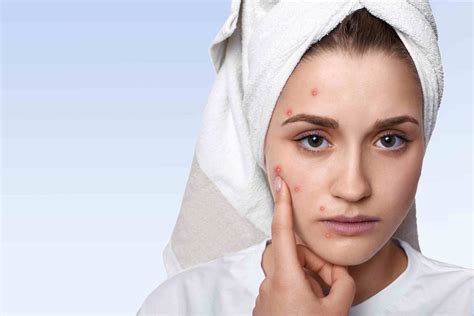 Acne Woes It Could Be Your Lymphatic Nodes System
