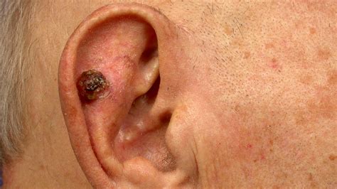Ear Cancer Types Symptoms Causes Treatments And More