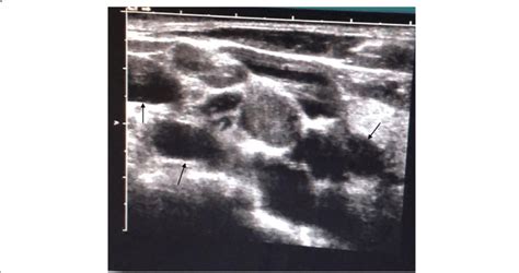 Supraclavicular Lymph Node Ultrasound