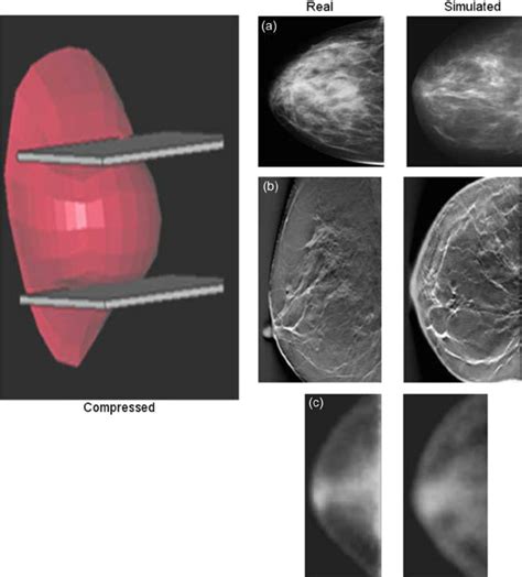 A Mammogram B Tomosynthesis And C Positron Emission Mammography