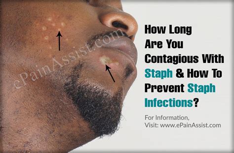 Some organisms like salmonella, campylobacter, norovirus, and e. How Long Are You Contagious With Staph & How To Prevent ...
