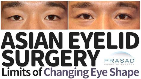 Facelift Surgery And Eyelid Surgery By Dr Amiya Prasad New York