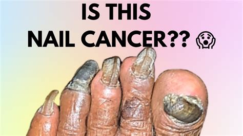 Is This Nail Cancer Symptoms How To Identify Nail Cancer