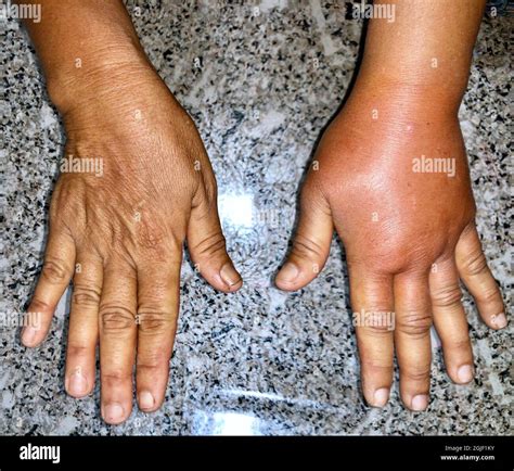 Oedema High Resolution Stock Photography And Images Alamy