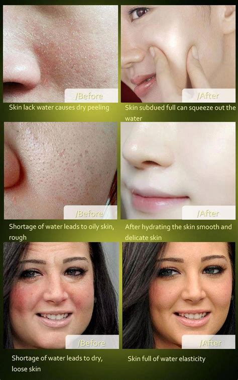 How To Get Rid Of Brown Spots On Deal With Removebrownspotsonface