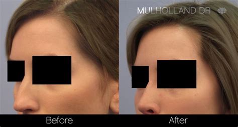 Rhinoplasty Before And After Photos In Toronto SpaMedica Rhinoplasty Facial Surgery
