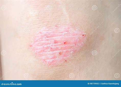 Psoriasis On The Knee Shows Redness And Applying And Dry Flaky S Stock