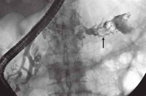 Ercp Showing Main Duct Ipmn Md Ipmn Mucus Presenting As A Filling