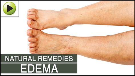 Edema Natural Ayurvedic Home Remedies Youtube